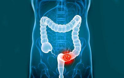 23-signs-and-symptoms-of-colorectal-cancer
