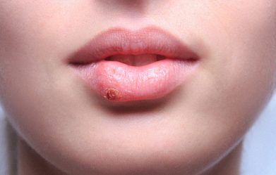 29-home-remedies-to-get-rid-of-cold-sores