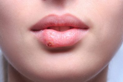 29-home-remedies-to-get-rid-of-cold-sores