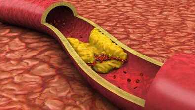 what-you-need-to-know-about-how-to-prevent-and-treat-high-cholesterol