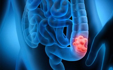 doctors-explain-that-screening-for-colorectal-cancer-should-be-done-as-early-as-the-age-of-45