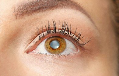 what-everyone-should-know-about-cataracts-a-common-eye-problem