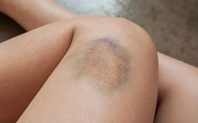 things-you-should-know-about-bruising-easily