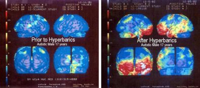 new-study-finds-that-hyperbaric-oxygen-therapy-could-slow-down-the-progression-of-alzheimers