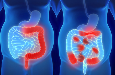 medical-myths-you-need-to-know-about-ibd