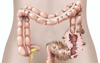 10-signs-and-symptoms-of-diverticulitis