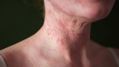 eczema-may-possibly-lead-to-other-health-issues-scientists-find