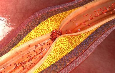 research-group-finds-new-strategy-to-help-prevent-arteries-from-clogging