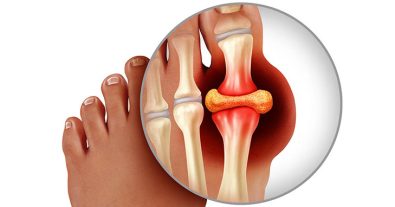 4-gout-symptoms-you-should-know-about