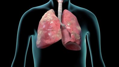 sleep-issues-could-possibly-be-linked-to-increased-risk-for-critical-copd-flare-ups