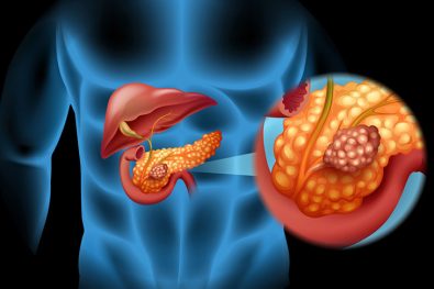 pancreatic-cancer-treatment-may-be-available-with-a-new-combination-of-drugs
