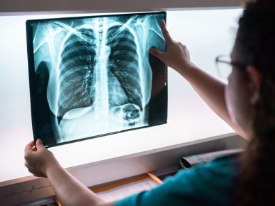 almost-50-of-those-with-abnormal-lung-cancer-screening-delay-follow-up-with-care-specialists