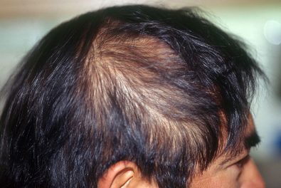 hair-growth-may-be-the-solution-as-fda-has-given-its-stamp-of-approval-to-an-alopecia-drug