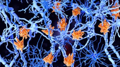 trial-of-experimental-drug-for-alzheimers-slows-down-mental-decline-by-an-astonishing-27