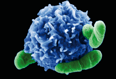 the-new-car-t-cell-therapy-the-answer-for-lupus-patients
