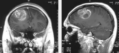 research-finds-achilles-heel-of-brain-cancer-hopes-to-treat-deadly-glioblastoma-in-new-ways