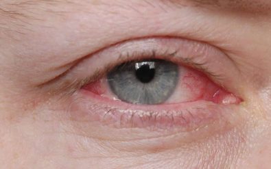 20-home-remedies-to-help-relieve-pink-eye