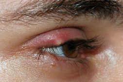 10-tips-and-treatments-on-styes