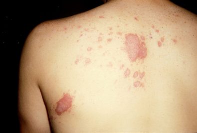 how-a-fungal-disease-called-valley-fever-is-becoming-more-common