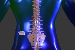 fda-finally-gave-its-approval-for-spinal-cord-simulators-helping-those-who-suffer-from-chronic-back-pain