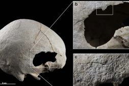 skull-of-woman-from-stone-age-shows-that-she-underwent-two-head-surgeries-and-survived