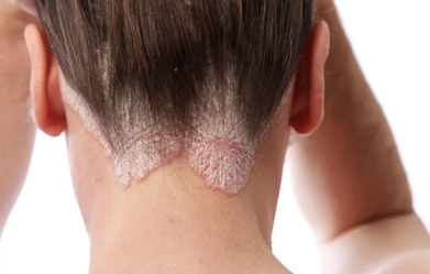 fda-approves-new-foam-treatment-to-treat-scalp-eczema-in-adults-and-children
