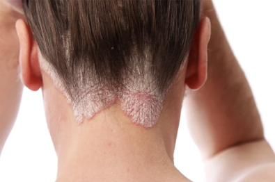 fda-approves-new-foam-treatment-to-treat-scalp-eczema-in-adults-and-children