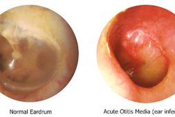 a-new-app-launched-and-uses-ai-to-intuitively-diagnose-ear-infections