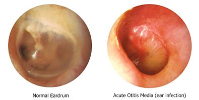 a-new-app-launched-and-uses-ai-to-intuitively-diagnose-ear-infections