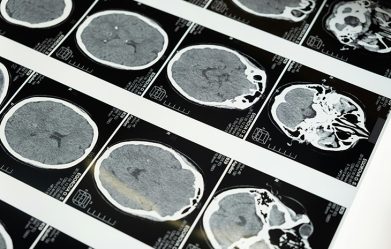 new-glioblastoma-treatment-achieves-almost-complete-tumor-regression-in-brain-cancer-just-five-days-after