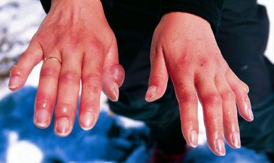 fda-approves-novel-drug-for-frostbite-patients-to-save-fingers-and-toes-from-amputation