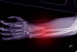 revolutionary-way-to-heal-broken-bones-faster-could-also-make-them-3-times-stronger
